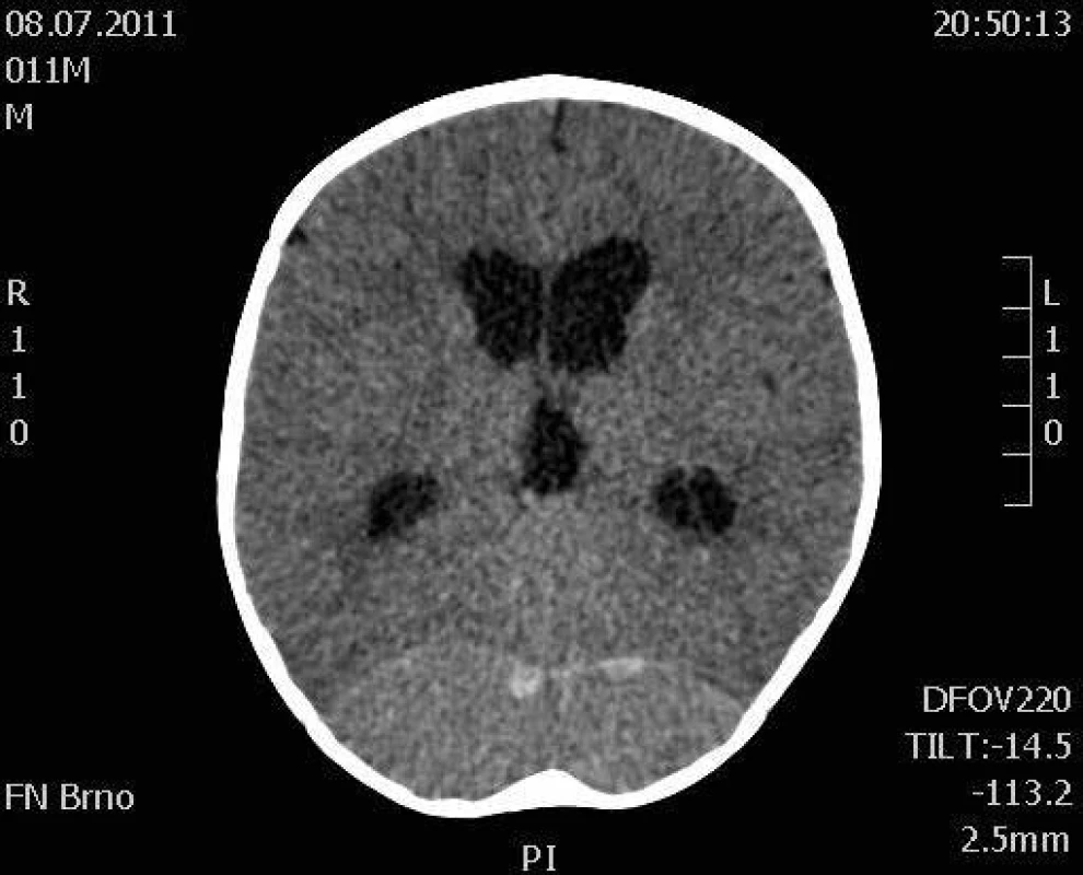 CT scan mozku, v axiální rovině. Okcipitálně je patrný rozsáhlý hematom. Dále je zřejmá dilatace komorového systému a redukce zevních likvorových prostor.
Fig. 1. CT scan of the brain shows large lenticular hematoma of occipital region, with dilatation of ventricular system and reduction of external liquor spaces. Axial scan.