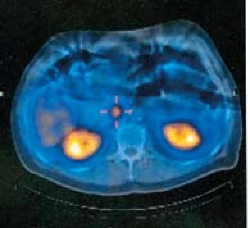 SPECT patologické ložisko v oblasti hlavy pankreatu.