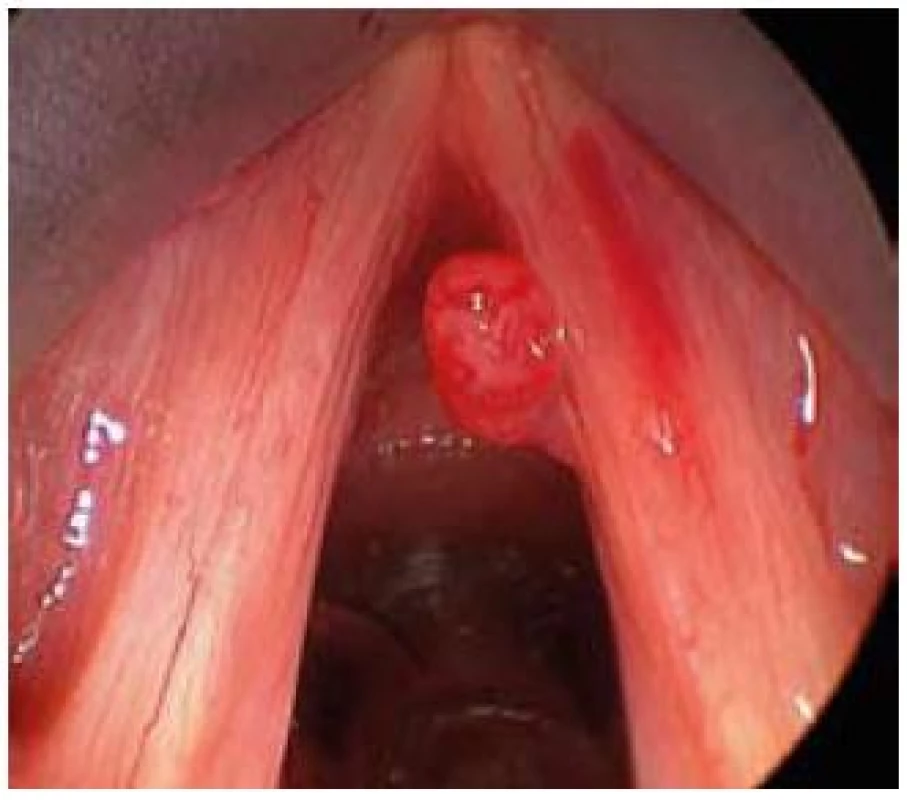 Hemangiom pravé hlasivky.
Fig. 6. Right vocal cord haemangioma.