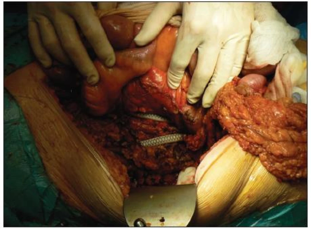 Odhalená cievna protéza po ľavostrannej hemikolektómii
Fig. 3. Visible vascular prosthesis after left hemicolectomy