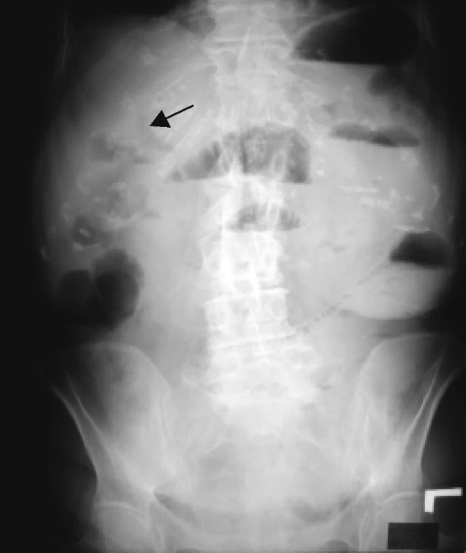RTG brucha – vysoký ileus a aerobília – označená šípkou
Pic. 6. X ray of abdomen – high ileus and aerobilia – marked with arrow
