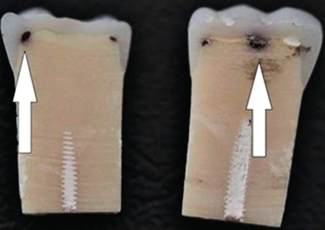 Dvouvrstvé zuby s kazivou lézí Nissin