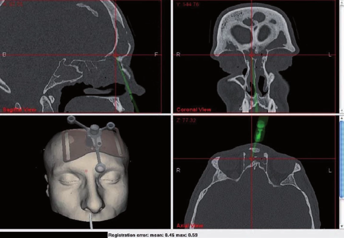 Příklad CT navigace při chronické rinosinusitidě s nosní polyózou s pozicí navigační sondy v oblasti vývodu čelní dutiny
