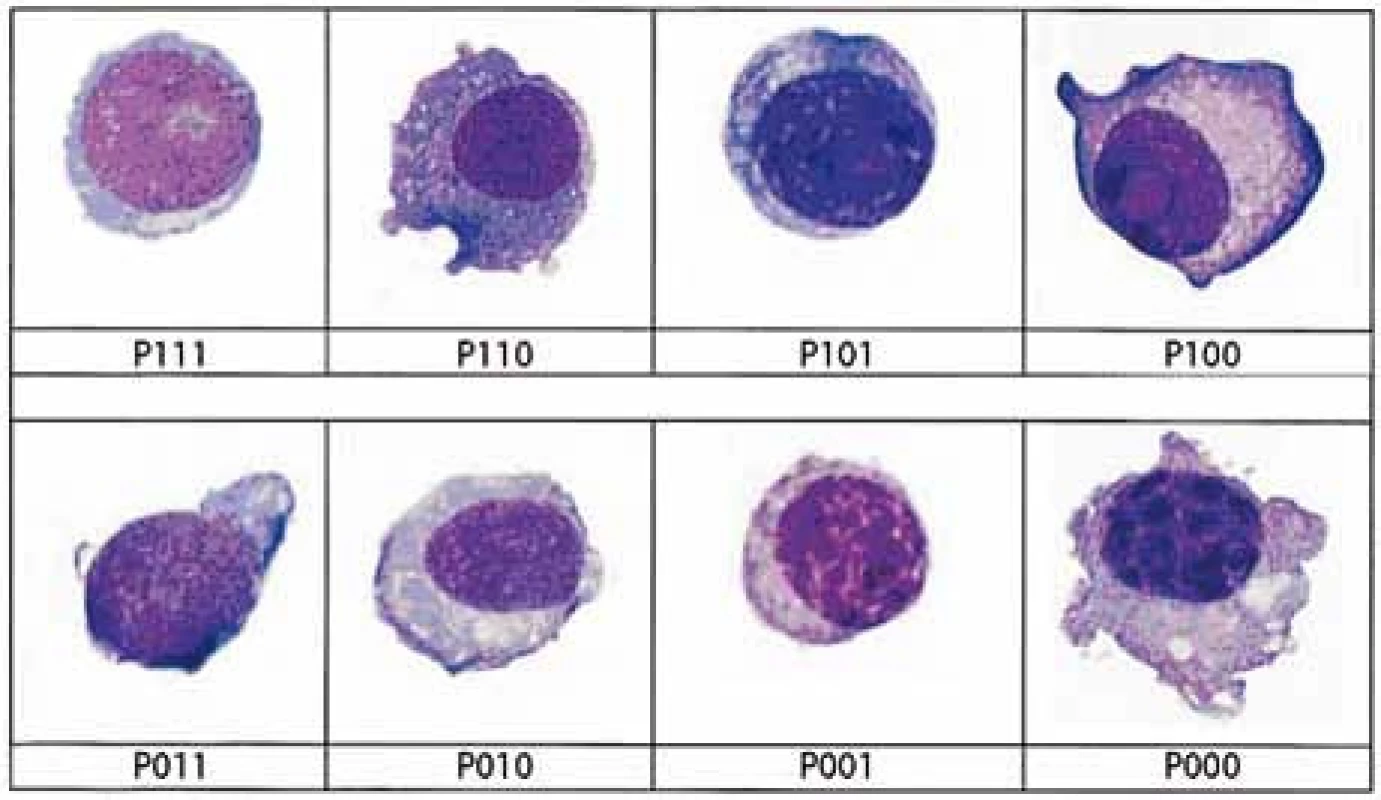 Přehledná zastoupení plazmocytů dle používaného algoritmu. Buňky s jadérkem jsou definováné jako P111, P110, P101, P100. Buňky s blastickým chromatinem jsou definovány jako P111, P110, P011, P010 a buňky s velmi vysokým N: C poměrem (&lt; 0,6) jsou P111, P101, P011, P001.