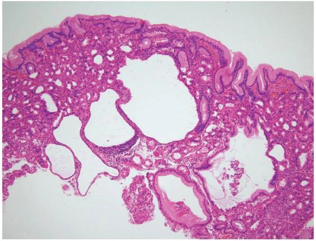 Cystický polyp žlázek žaludečního těla, s charakteristickou dilatací žlázových struktur žaludečního těla (HE, 100×)