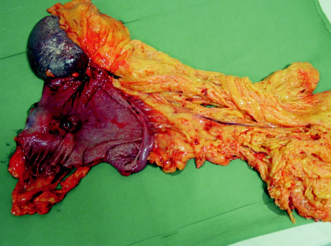 Resekát – en block preparát žaludek s tumorem, omentem a slezinou
Fig. 3. The resecate – en block preparation of the stomach with the tumor, the omentum and the spleen