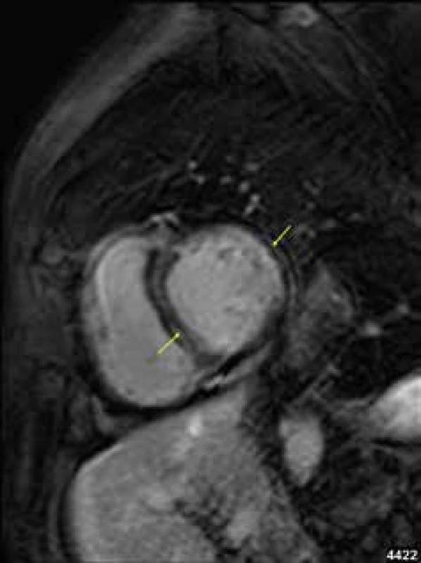 Midmyokardiální pruhovitá ložiska pozdního sycení kontrastní látkou (LGE) v septu komor i volné stěně levé komory (žluté šipky) u nemocného s dilatační kardiomyopatií; projekce na krátkou osu levé komory