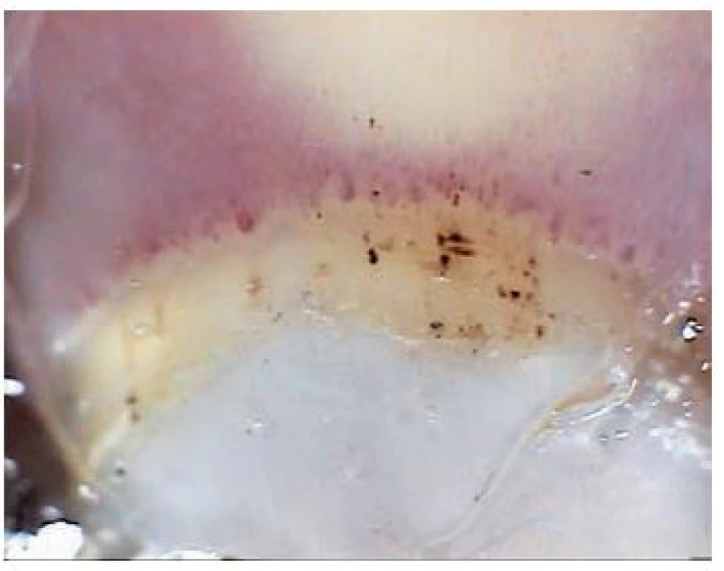 Kapilaroskopie nehtového valu – systémová sklerodermie typu akrosklerózy 
Nepravidelná organizace kapilár, redukce jejich počtu, viditelné megakapiláry a drobné krvácení v oblasti kutikuly.