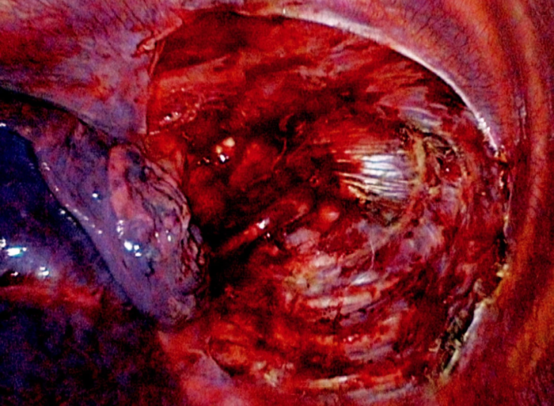 Apikální parciální pleurektomie vlevo (operační foto)
Fig. 4. Partial apical pleurectomy on the left (intraoperative photo) 