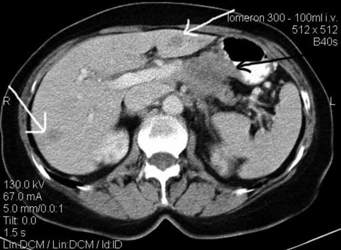 Rozsáhlý tumor těla pankreatu s infiltrací portální žíly, truncus coeliacus a žaludku (černá šipka). Patrné bilobární metastatické postižení jater (bílé šipky). Chirurgická léčba u tohoto pacienta není indikována.