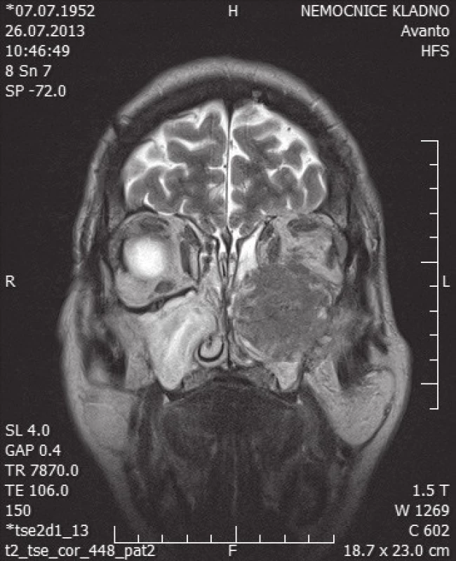 MR hlavy – koronární řez
