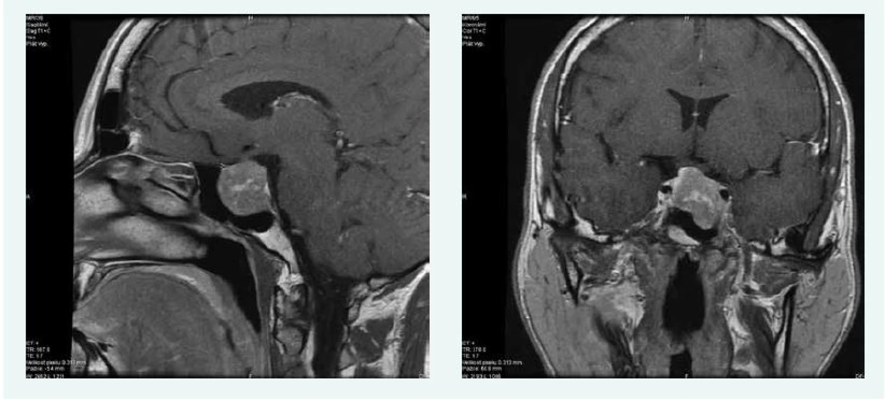 Kazuistika 3 – makroadenom hypofýzy (MRI) (snímky v plném rozlišení naleznete v on-line verzi článku)