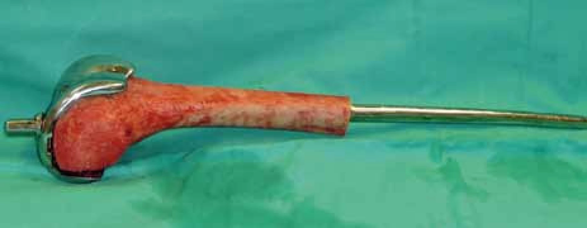 Peroperační foto – femorální část kompozitní endoprotézy (homoštěp distálního femuru + femorální komponenta) na instrumentačním stolku.