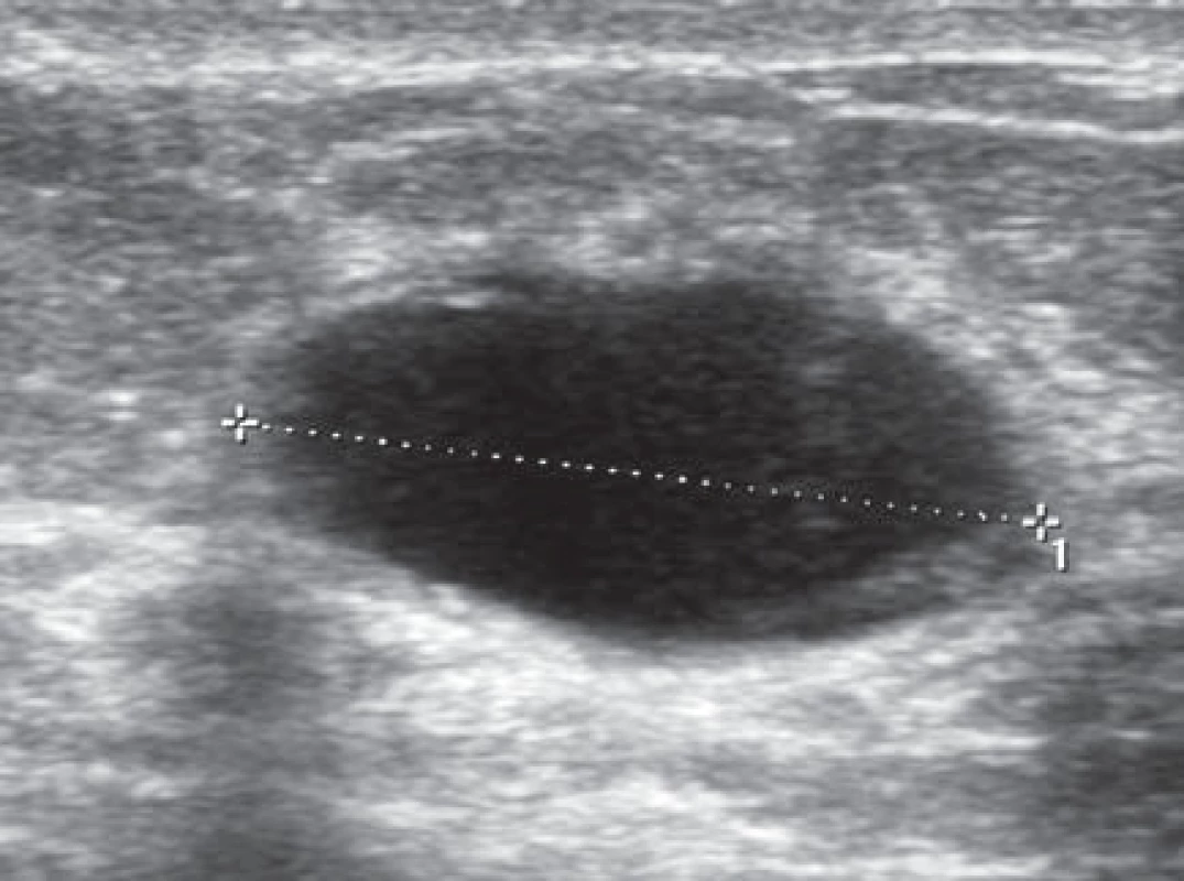 Ultrasonografi cký obraz benigní cysty