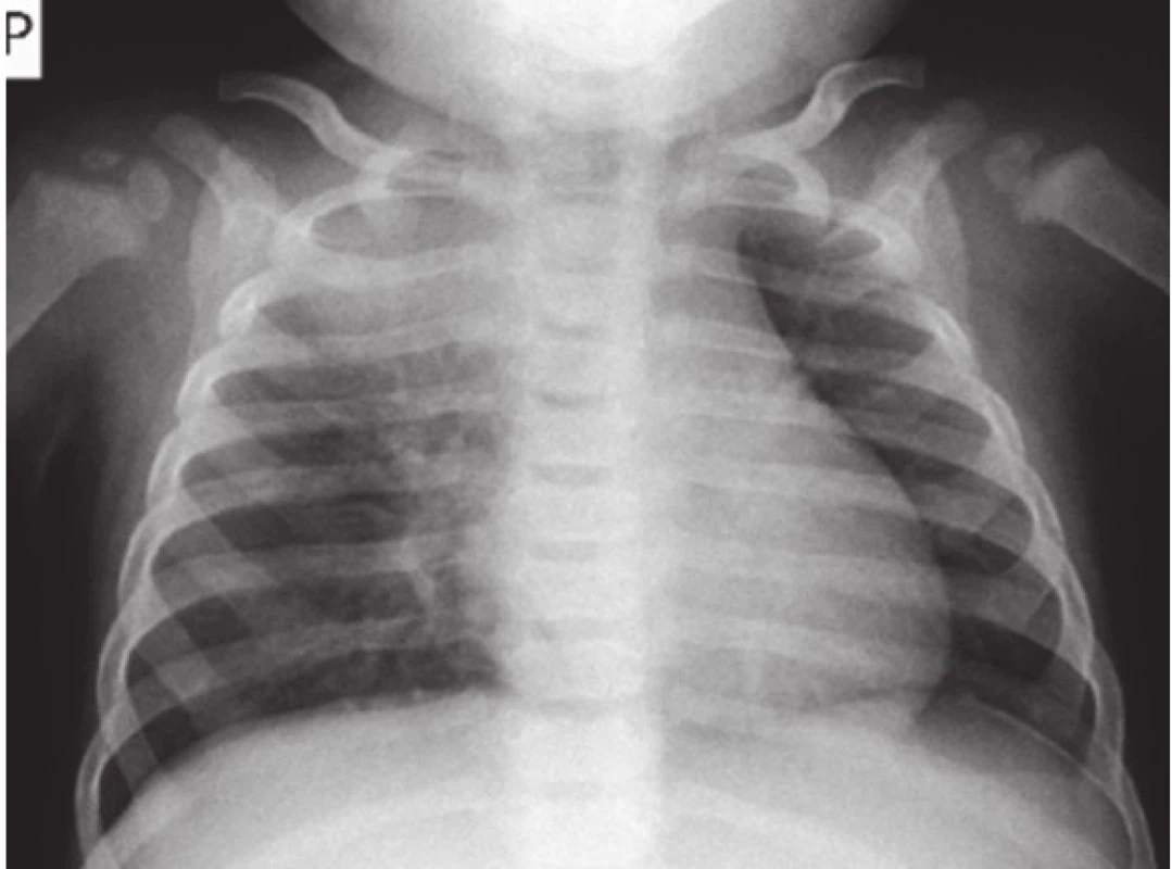 Vstupní RTG snímek plic.
Fig. 2. Chest X-ray of infant on admission.