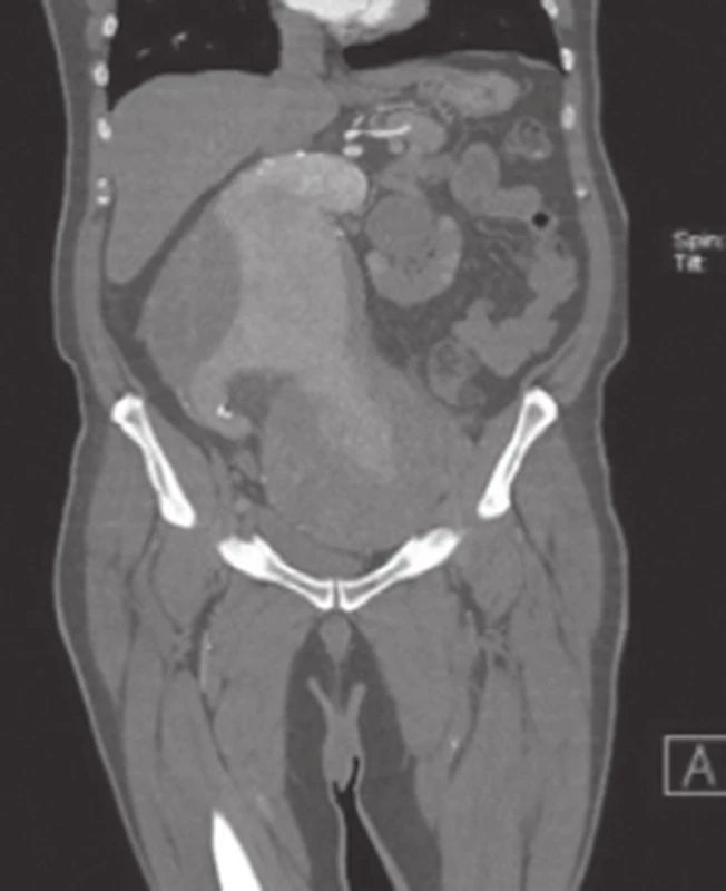 CT AG gigantického AAA ve frontální rovině – patrna hydronefróza levé ledviny
Fig. 3. CT AG of giant AAA in the frontal plane – with visible hydronephrosis of the left kidney