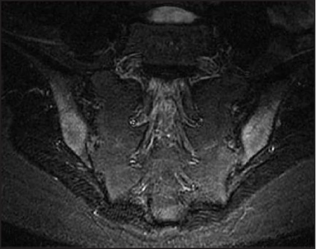 MR obraz oboustranné sakroileitidy (kostní edém obklopující sakroiliakální klouby a subchondrální skleróza kosti)