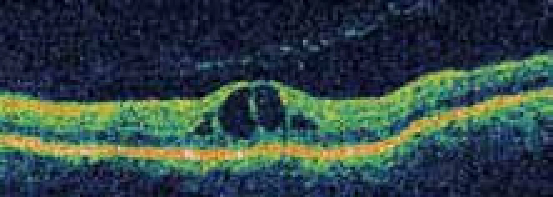 Cystoidní makulární edém levého oka zobrazený pomocí optické koherentní tomografie.