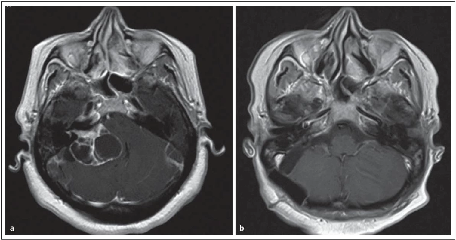 Cystický vestibulární schwannom st. IV.
Obr. 6a) MR před operací.
Obr. 6b) Úplné odstranění nádoru se zachováním lícního nervu.