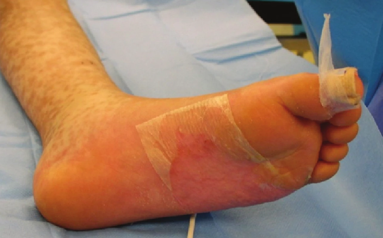 Exfoliované plochy kryté xenotransplantáty na plosce levé nohy
Fig. 6: Exfoliated areas covered with xenotransplants on the sole of the left foot