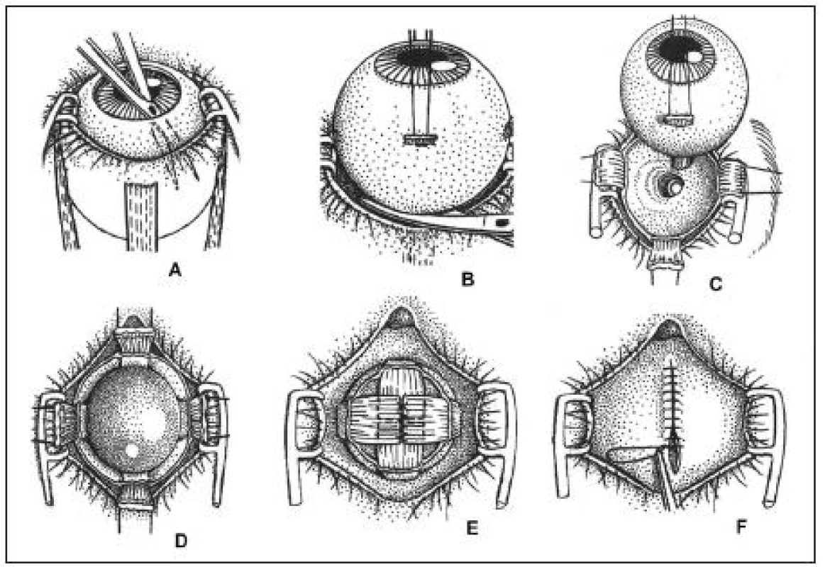 Schéma fáz postupu pri aplikácii pohyblivého orbitálneho implantátu po enukleácii očnej gule. Vysvetlenie v texte