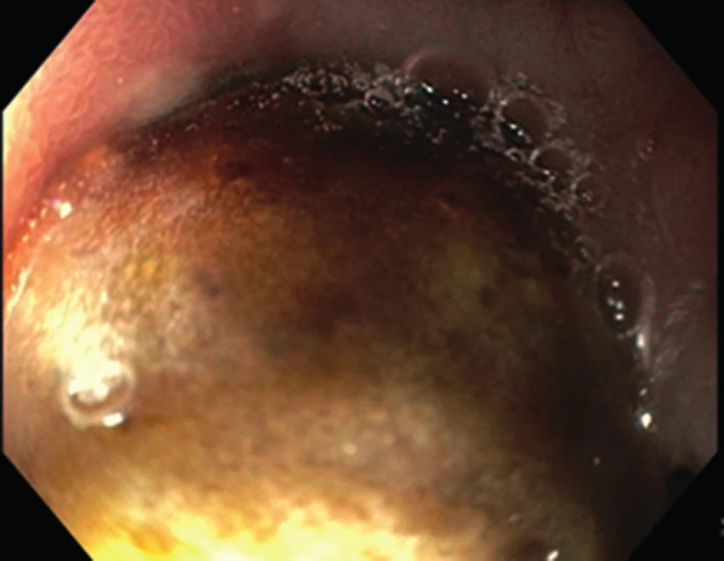 EGDS snímek s konkrementem v duodoenu
Fig. 2: EGDS image of a gallstone in the duodenum