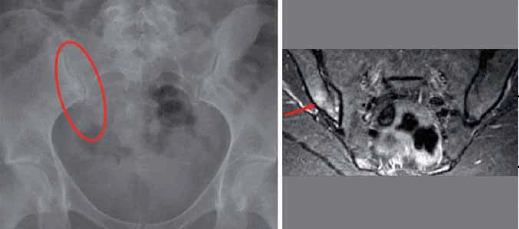 Jednostranná sakroiliitida II. st. vpravo (subchondrální sklerotizace, susp. incip. eroze) a nález podle MRI – edém kostní dřeně v oblasti pravého SI skloubení.