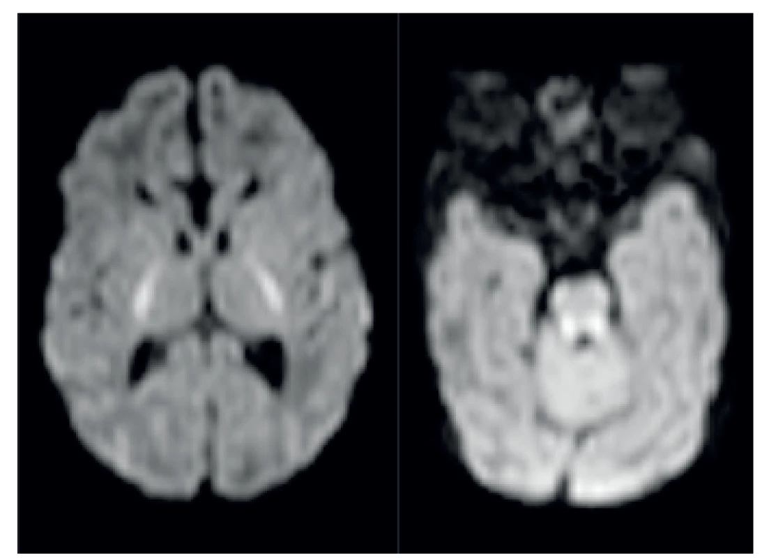 MR patologicky zvýšený signál symetricky v pontu a v oblasti horních a středních mozečkových pedunkulů.
Fig. 4. MRI pathologically high signal in pontus and midle pedunculus cerebellaris.