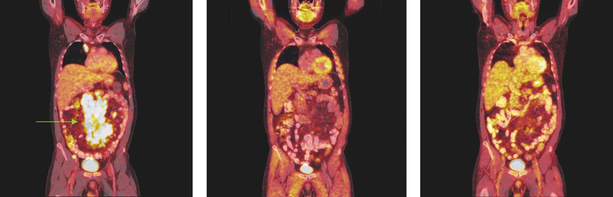 Série PET/CT snímků u nemocného s difuzním B-velkobuněčným lymfomem před léčbou, po 2 cyklech léčby a po ukončení léčby. První snímek ukazuje mnohočetná ložiska hypermetabolismu glukózy ve zvětšených lymfatických uzlinách infraklavikulárně a v dutině břišní kolem břišní aorty a v mezenteriu a kolem pánevních cév. Po 2 cyklech léčby došlo ke zmenšení všech lymfatických uzlin, žádná nevykazuje hypermetabolismus glukózy a po skončení léčby je patrná normalizace velikosti lymfatických uzlin, všechny bez hypermetabolismu glukózy.