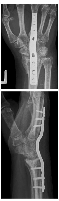 a) Totální artrodéza zápěstního kloubu pomocí speciální kompresní dlahy – předozadní snímek.
b) Boční snímek u téhož pacienta