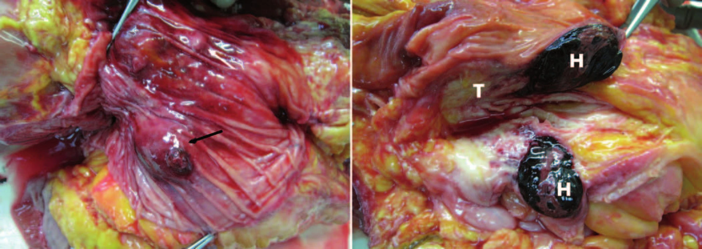 Pitevný nález. Vľavo: pohľad na sliznicu duodena, hematóm a miesto krvácania označené čiernou šípkou, Vaterská papila označená bielou šípkou. Vpravo: pohľad na reze – hematóm v stene duodena (H) a tumor hlavy pankresu (T).
Fig. 4. Autopsy findings. Left: a view of the duodenal mucosa, hematoma and bleeding site identified by a black arrow, Vater papilla marked with a white arrow. Right: cross-sectional view of a hematoma in the wall of the duodenum (H) and tumor of pancreas head (T).