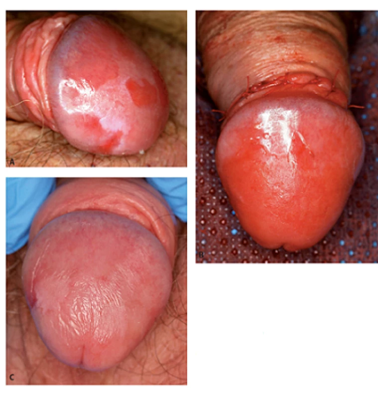 Muž, 81 let, simplexní PeIN (biopticky ověřený) na glans penisu: před léčbou (3A), bezprostředně po léčbě (cirkumcize a ablace s Er: YAG laserem – 3B) a 2 měsíce po výkonu (3C)
Fig. 3. Man, 81-year-old, simplex PeIN (histologically verified) of the glans penis: before (3A), immediately after treatment (circumcision and Er: YAG laser ablation – 3B) and 2 months after therapy (3C)