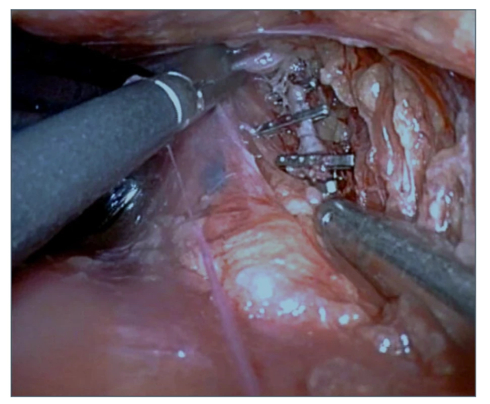 Zaklipování ductus thoracicus<br>
Fig. 6: Clipping of the thoracic duct