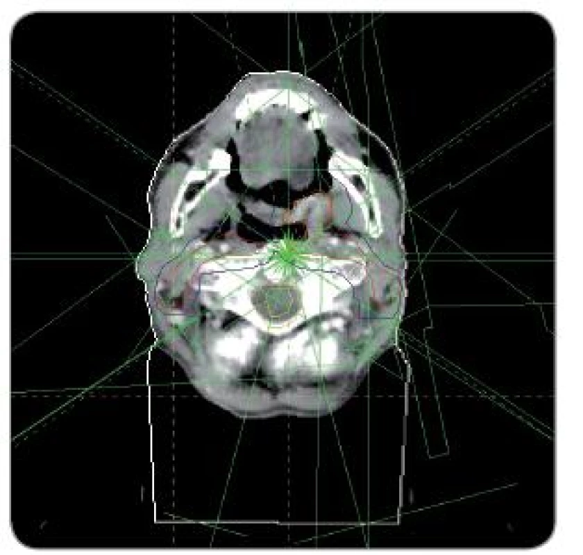 Plánovací CT snímek s vyznačenými cílovými objemy a ozařovaných polí.