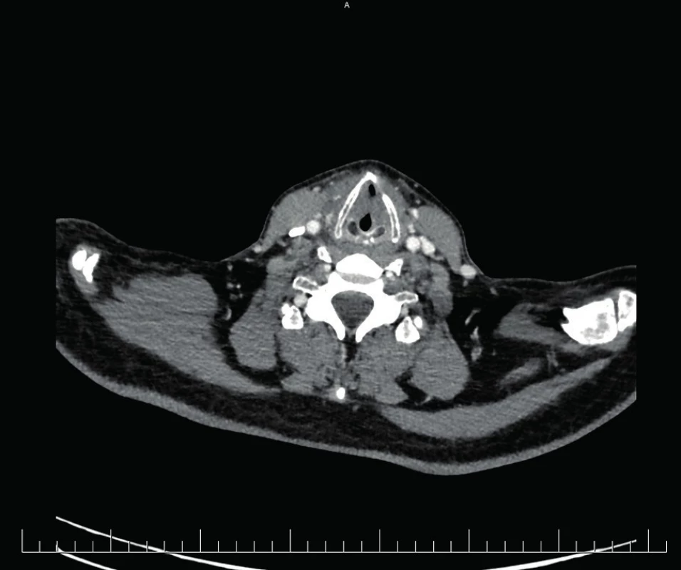 Kazuistika 2 – CT obraz stenózy trachey po PDT
