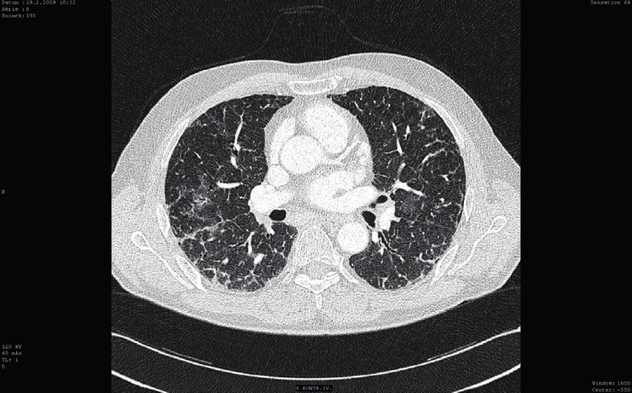 Kontrolní CT vyšetření plic (cca po 3 měsících)