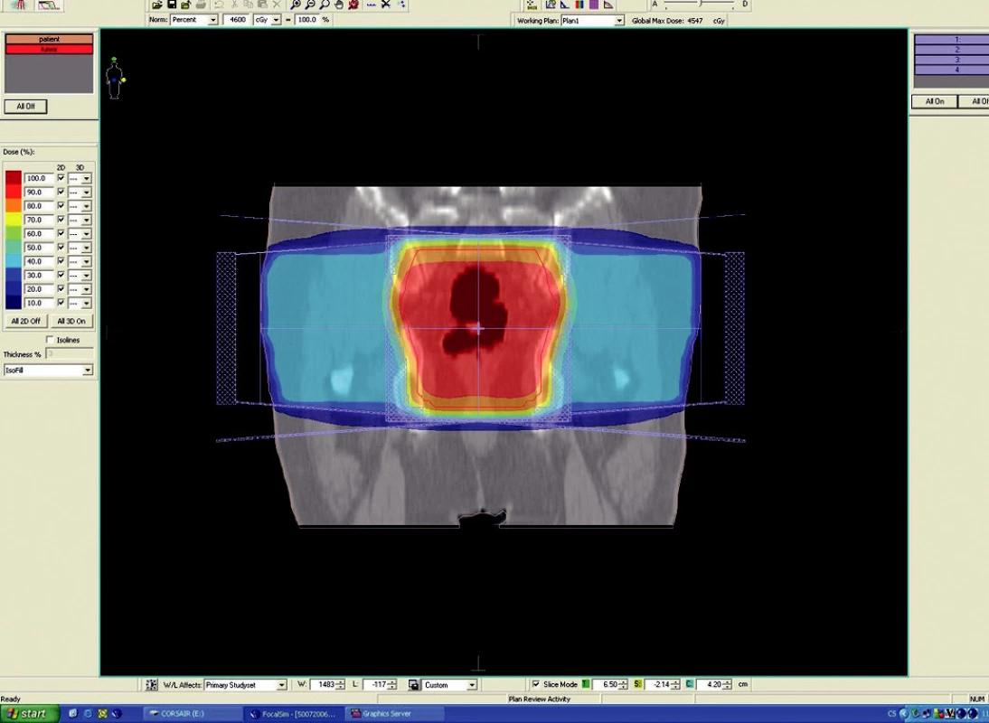 Plánovací CT vyšetření – předoperační ozáření karcinomu rekta cT3 NO MO – frontální rovina