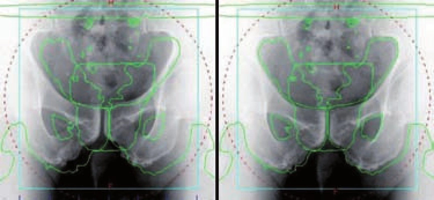 kV zobrazení v AP projekci – radioterapie řízená obrazem (IGRT)
Fig. 9 kV imaging in AP projection – image-guided radiation therapy (IGRT)