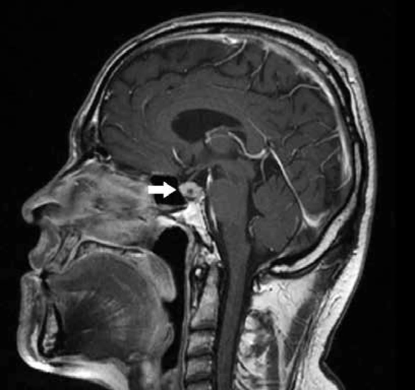 MRI mozku a hypofýzy:
