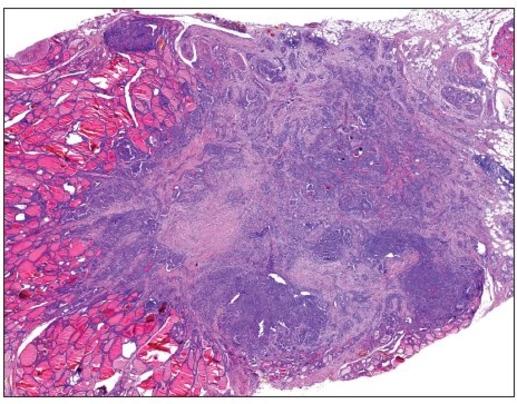 Papilární mikrokarcinom průměru 4 mm prorůstající skrze pouzdro štítné žlázy do okolního tuku (H&amp;E, 40krát