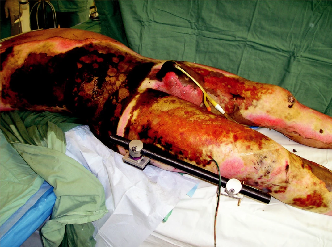 Status after the femoral fracture reposition by an external fixator in the burned area