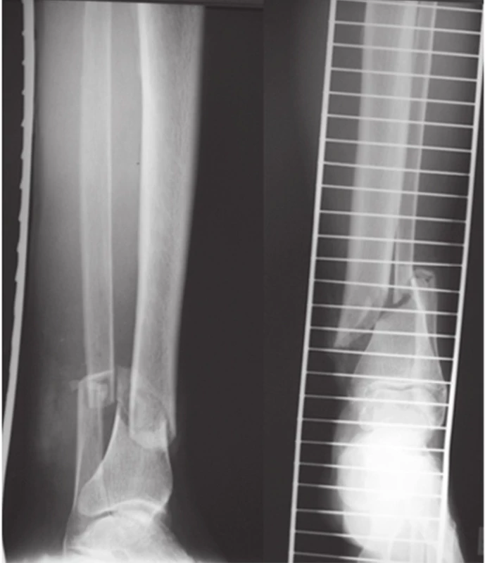 RTG natívne snímky – zlomeniny distálnej časti ľavej tíbie
Fig. 3: X-ray native scans – left distal tibial fracture