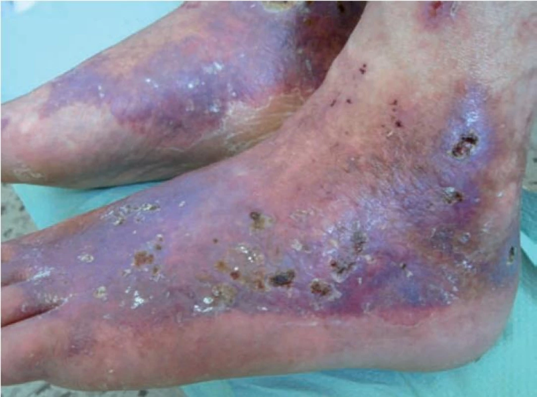 Livedo vaskulopatie: livedo racemosa, retiformní purpura a hvězdicovité ulcerace s hemoragickými krustami