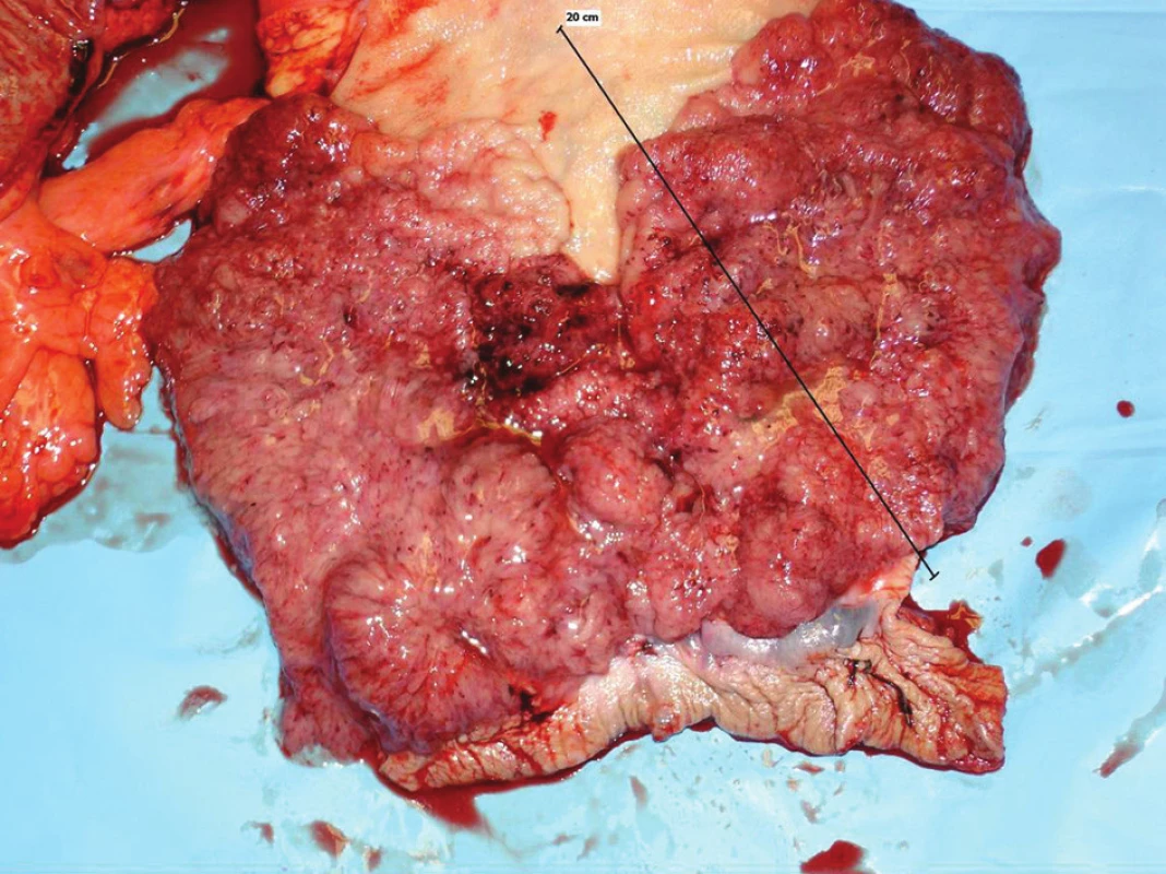 Resekát rekta s polypózou sliznice
Fig. 2: Resecate of the rectum with mucous membrane polyposis