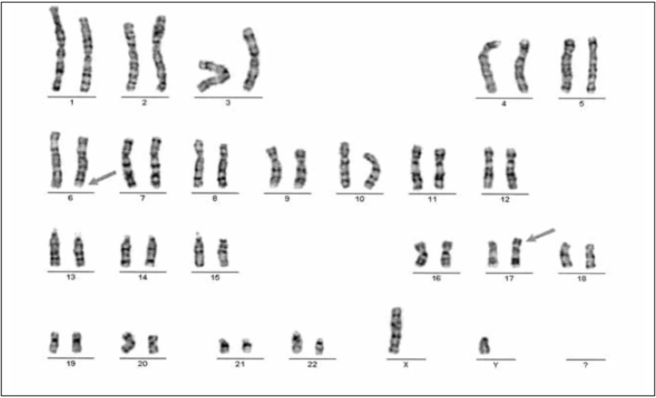 Karyotyp pacienta s anamnézou 2 spontánních potratů u partnerky balancovaná translokace, 46,XY,t (6;17)(q25.2;p13.1), G- banding.