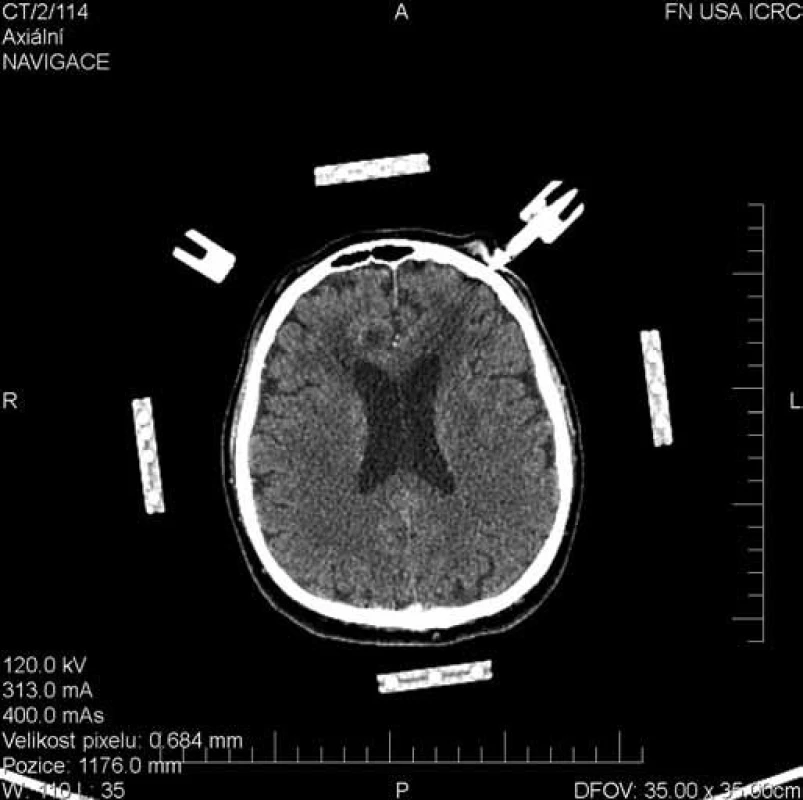 Plánovací CT scan pro stereotaktickou rámovou biopsii. Histologicky potvrzen difúzní velkobuněčný B lymfom mozku.
