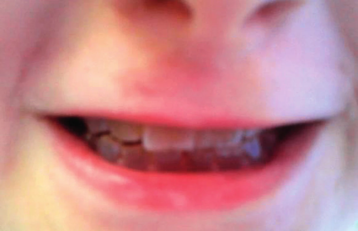 Dentinogenesis imperfecta.
Fig. 4. Dentinogenesis imperfecta.