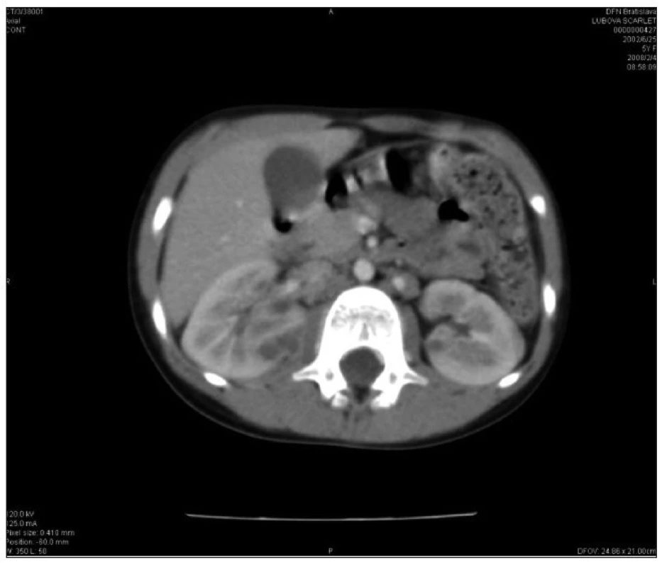 CT vyšetrenie: početné kortikálne a subkapsulárne oválne ložiská obličiek bilaterálne so zväčšenou pravou obličkou.
Fig. 2. CT imaging: numerous bilateral cortical and subcapsular oval foci with enlarged right kidney.