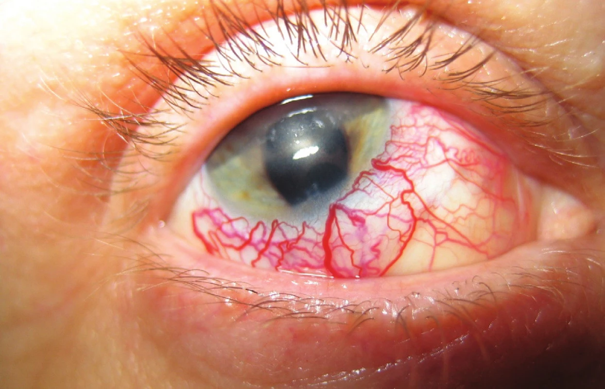 Klinický obraz predného segmentu oka – venektázie, predná komora po opakovaných zakrvácaniach (v r. 2007)