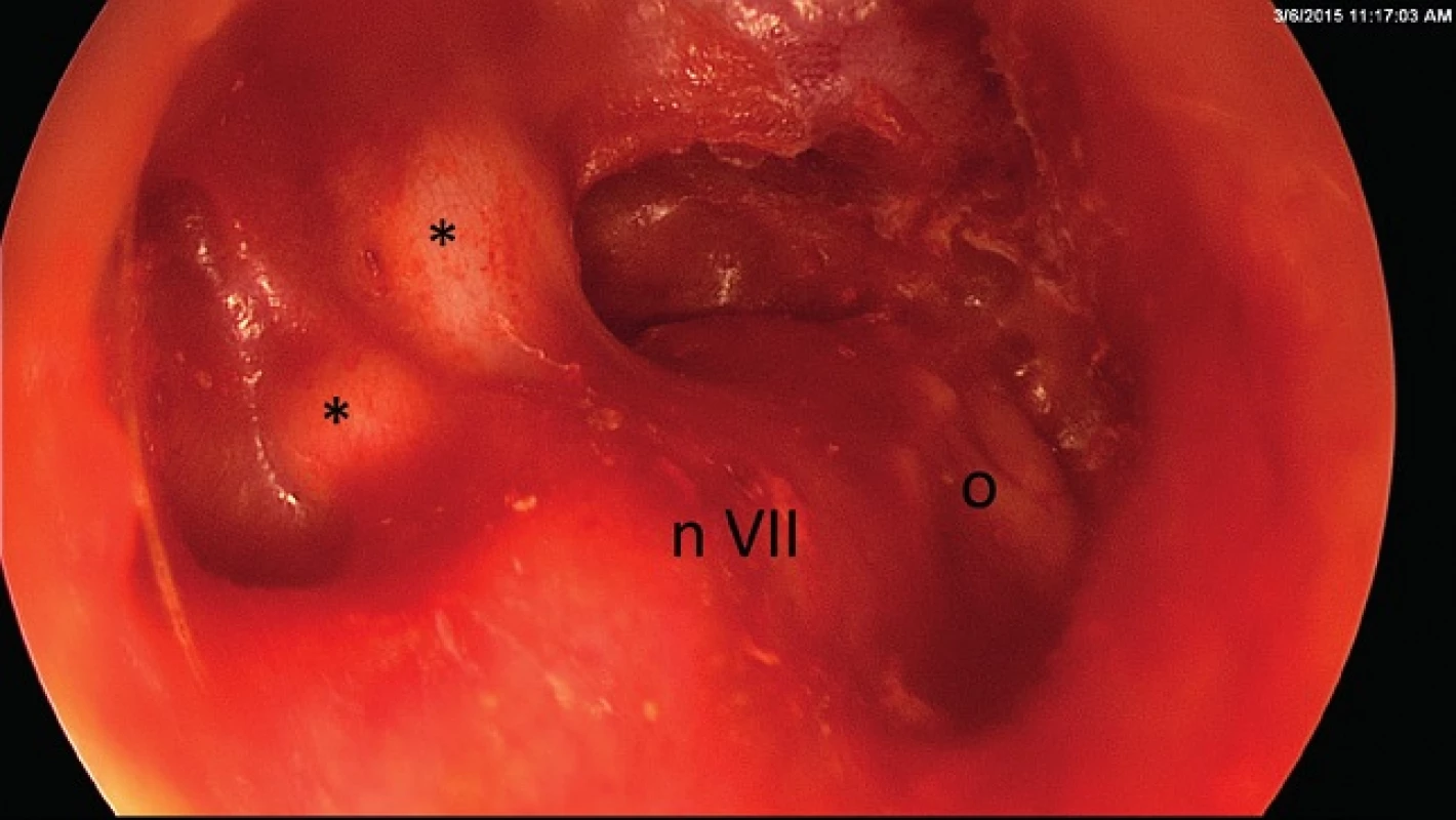 Pacient AK, 25 let, pravé ucho. Prosvítající cholesteatomové perly (*) v trepanační dutiny nalezené při ambulantní otoendoskopii. Patrný je ještě val lícního nervu a chrupavka (o) položena na protéze TORP v oválném okénku.